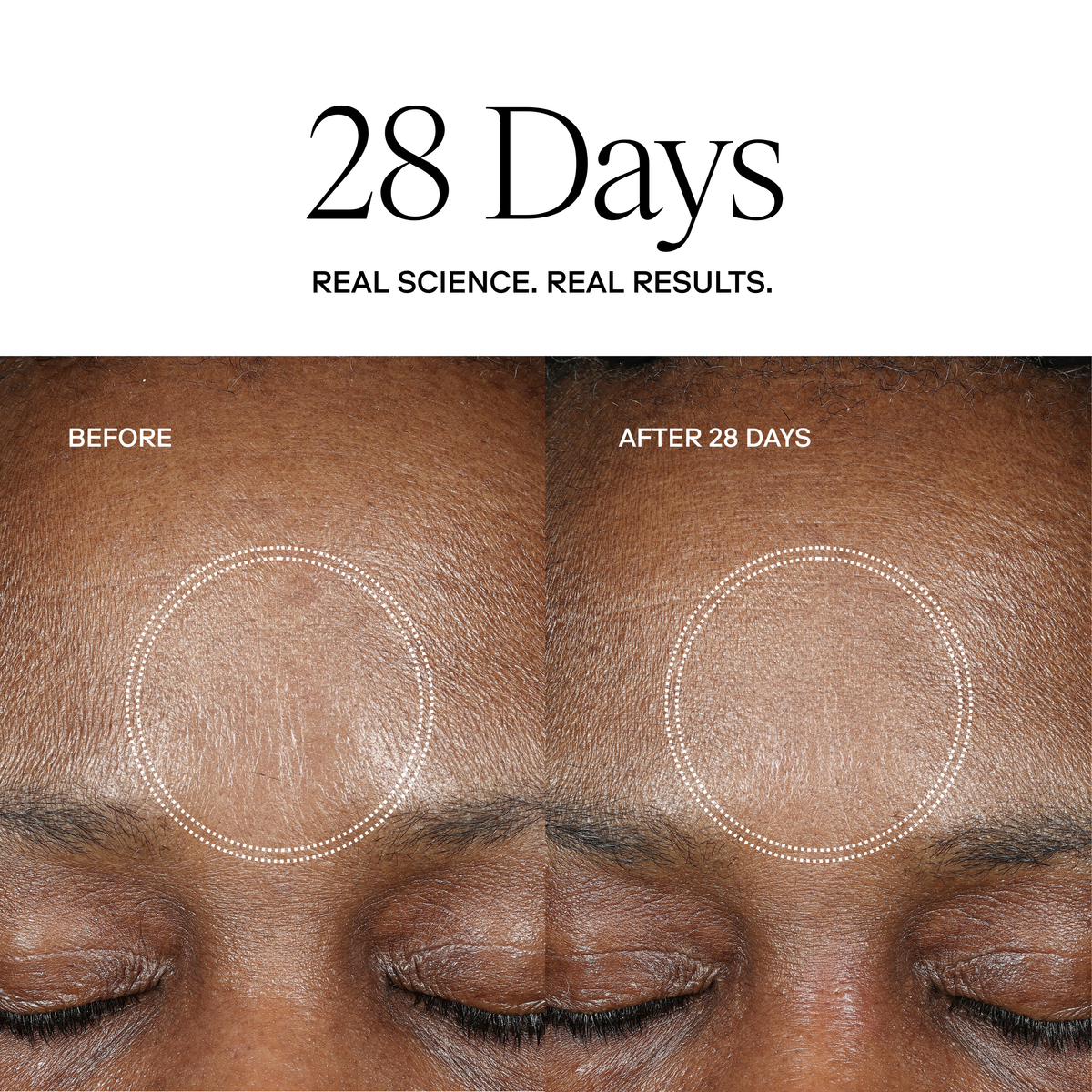 EXO H-SERUM™ Hyaluronic Acid Treatment / eXo³ Exosomes