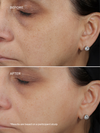 EXO H-SERUM™ Hyaluronic Acid Treatment
